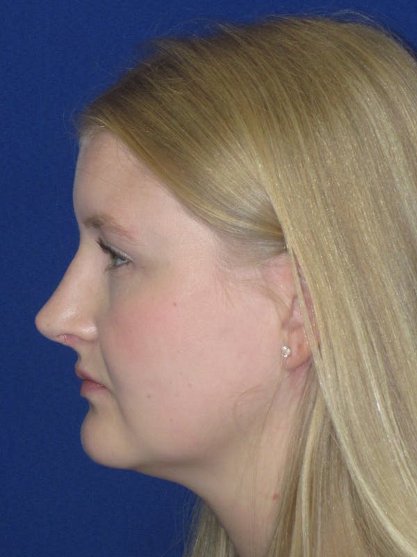 Rhinoplasty Before & After Gallery - Patient 199623 - Image 10