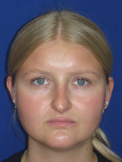 Rhinoplasty Before & After Gallery - Patient 199623 - Image 1
