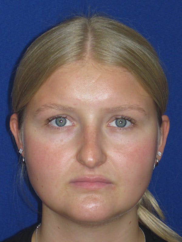 Rhinoplasty Before & After Gallery - Patient 199623 - Image 1