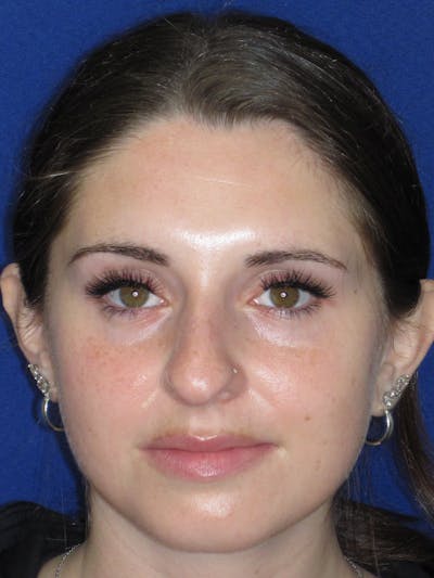 Rhinoplasty Before & After Gallery - Patient 402882 - Image 1
