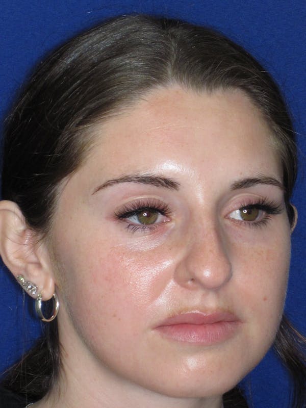 Rhinoplasty Before & After Gallery - Patient 402882 - Image 3