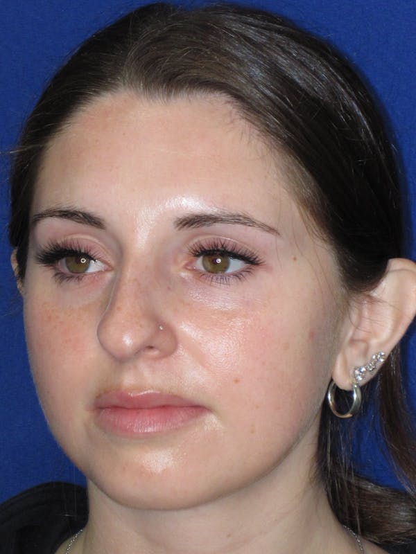 Rhinoplasty Before & After Gallery - Patient 402882 - Image 5