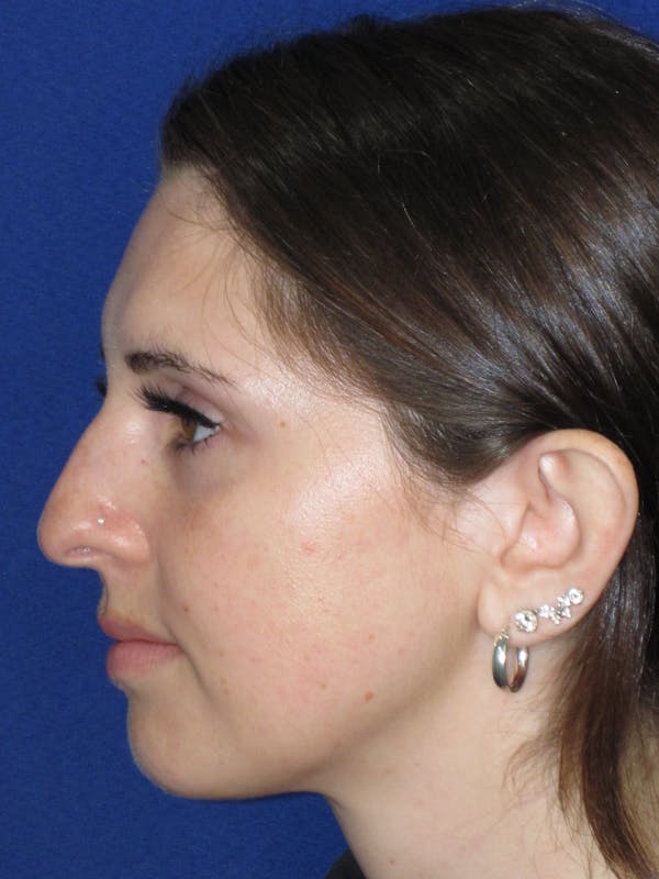 Rhinoplasty Before & After Gallery - Patient 402882 - Image 7