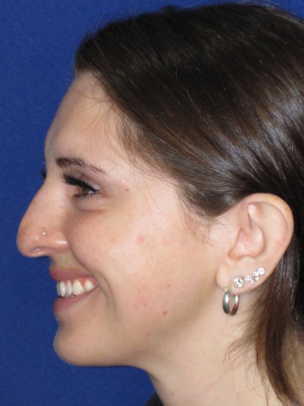 Rhinoplasty Before & After Gallery - Patient 402882 - Image 9