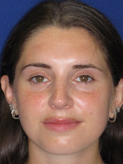 Rhinoplasty Before & After Gallery - Patient 402882 - Image 2