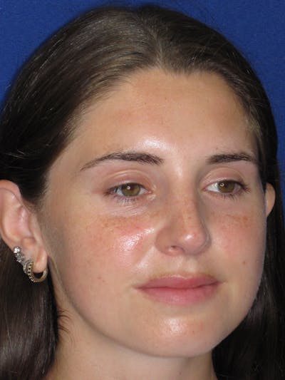 Rhinoplasty Before & After Gallery - Patient 402882 - Image 4