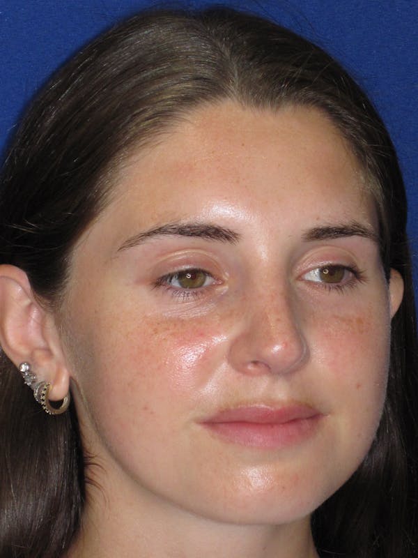Rhinoplasty Before & After Gallery - Patient 402882 - Image 4