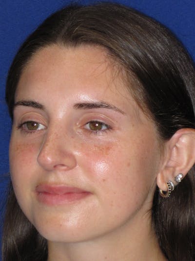 Rhinoplasty Before & After Gallery - Patient 402882 - Image 6