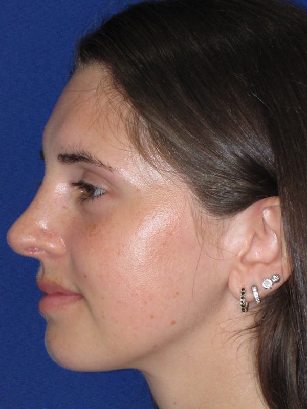 Rhinoplasty Before & After Gallery - Patient 402882 - Image 8