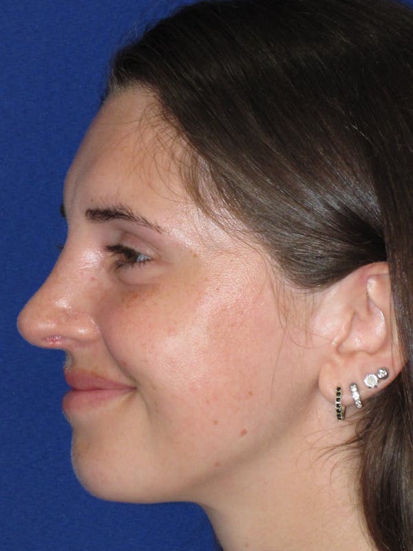Rhinoplasty Before & After Gallery - Patient 402882 - Image 10