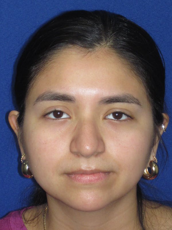 Rhinoplasty Before & After Gallery - Patient 121733 - Image 3