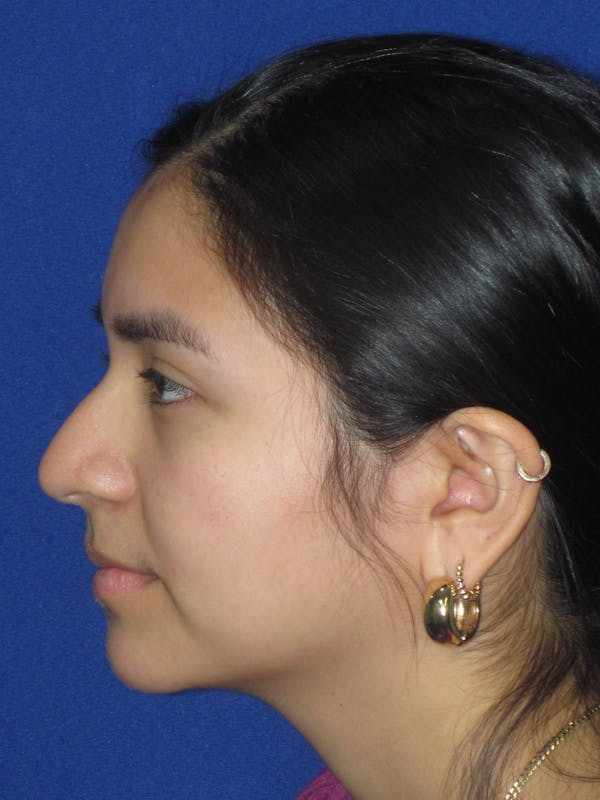 Rhinoplasty Before & After Gallery - Patient 121733 - Image 7