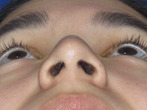 Rhinoplasty Before & After Gallery - Patient 121733 - Image 9