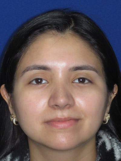 Rhinoplasty Before & After Gallery - Patient 121733 - Image 4