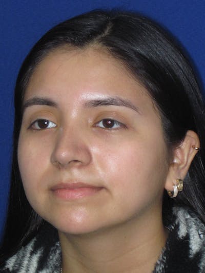 Rhinoplasty Before & After Gallery - Patient 121733 - Image 2