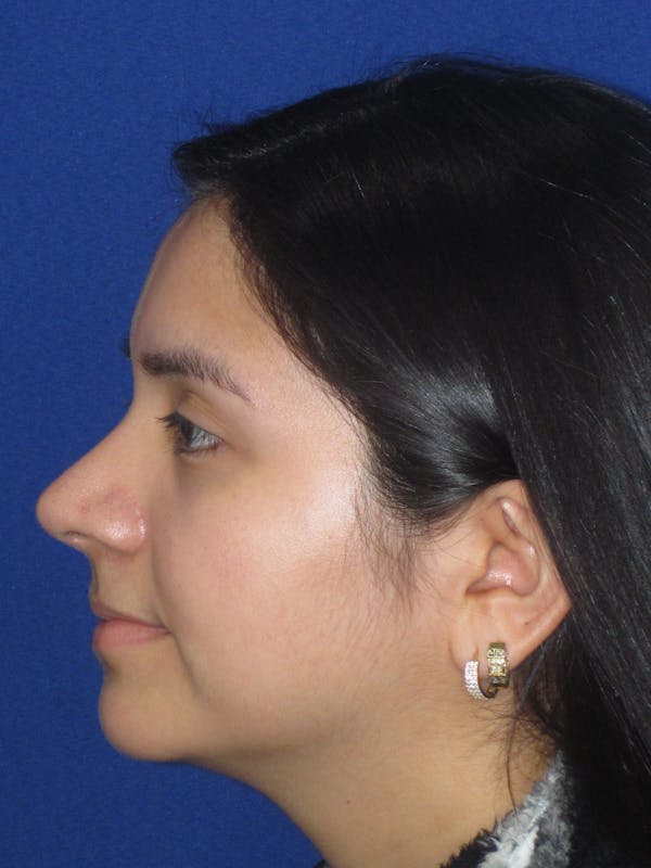 Rhinoplasty Before & After Gallery - Patient 121733 - Image 8