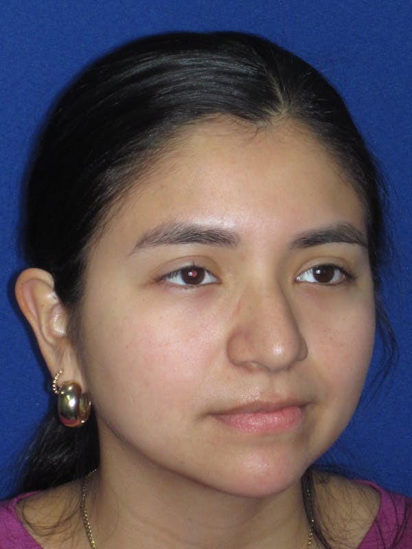 Rhinoplasty Before & After Gallery - Patient 121733 - Image 5