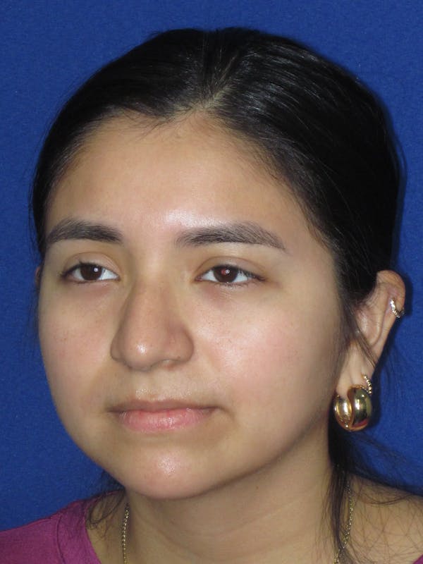 Rhinoplasty Before & After Gallery - Patient 121733 - Image 1
