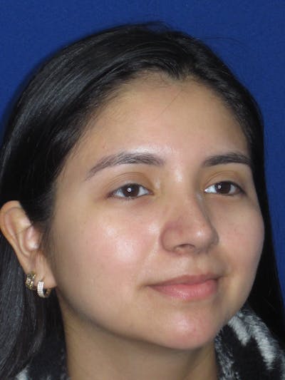 Rhinoplasty Before & After Gallery - Patient 121733 - Image 6