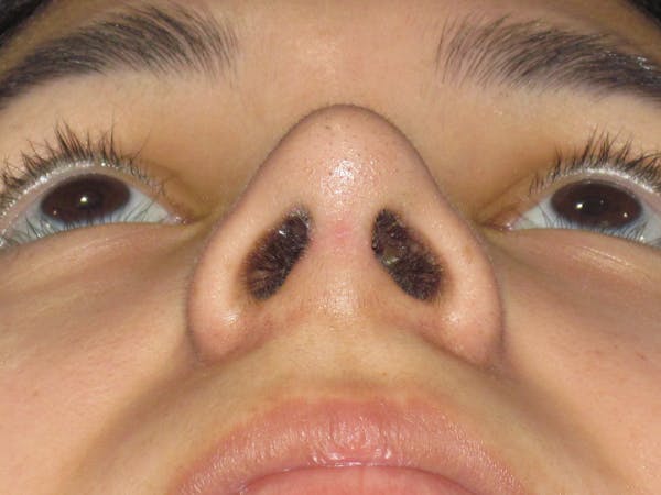 Rhinoplasty Before & After Gallery - Patient 121733 - Image 10