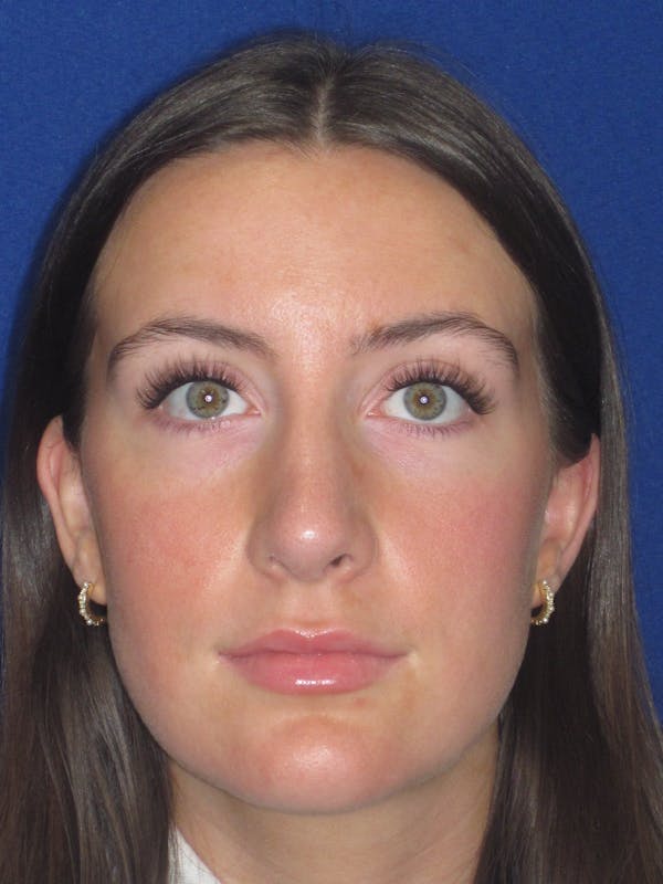 Rhinoplasty Before & After Gallery - Patient 428259 - Image 6