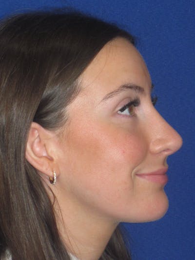 Rhinoplasty Before & After Gallery - Patient 428259 - Image 2