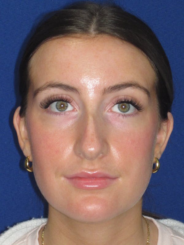 Rhinoplasty Before & After Gallery - Patient 428259 - Image 5