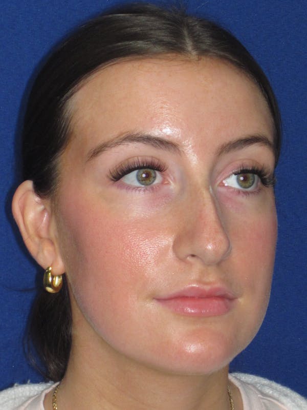 Rhinoplasty Before & After Gallery - Patient 428259 - Image 7