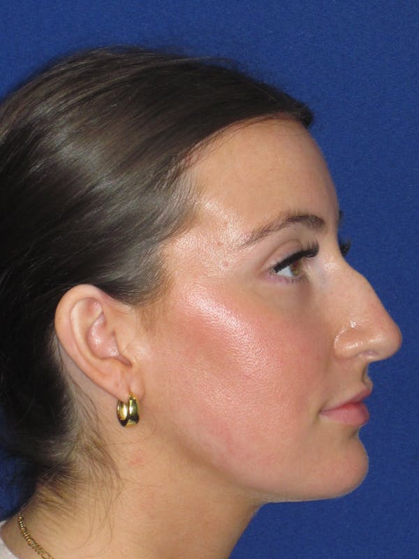 Rhinoplasty Before & After Gallery - Patient 428259 - Image 1
