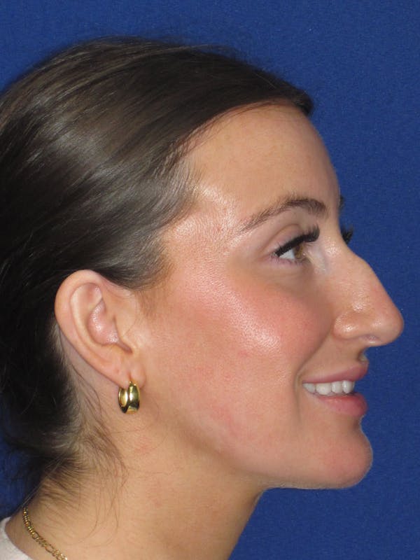 Rhinoplasty Before & After Gallery - Patient 428259 - Image 9