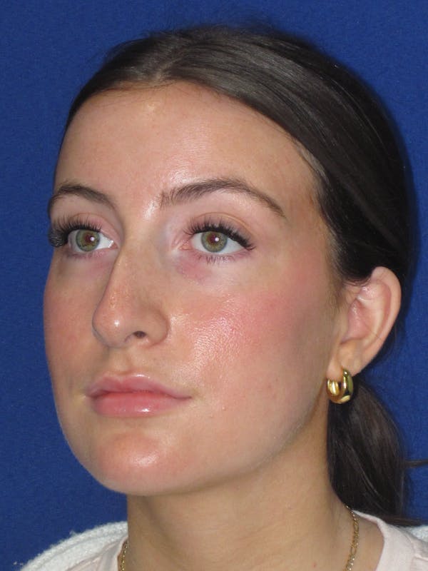 Rhinoplasty Before & After Gallery - Patient 428259 - Image 11