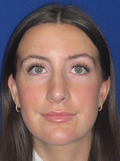 Rhinoplasty Before & After Gallery - Patient 428259 - Image 4