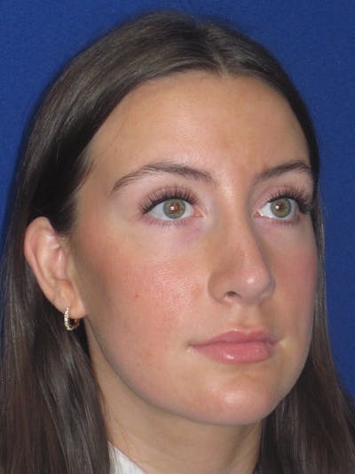 Rhinoplasty Before & After Gallery - Patient 428259 - Image 8