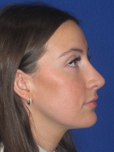 Rhinoplasty Before & After Gallery - Patient 428259 - Image 10