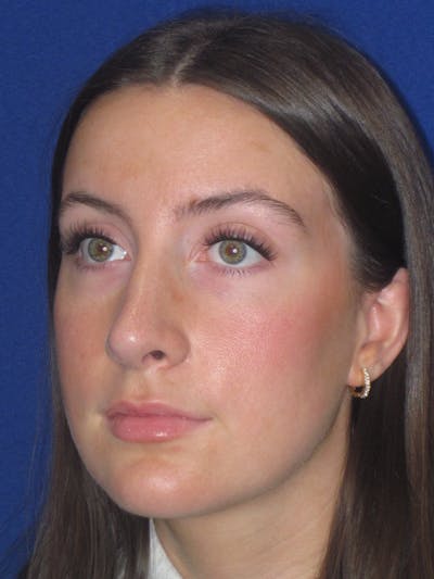 Rhinoplasty Before & After Gallery - Patient 428259 - Image 12