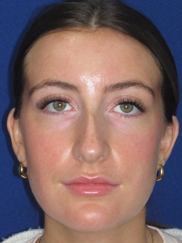 Rhinoplasty Before & After Gallery - Patient 428259 - Image 3