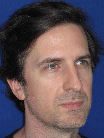 Rhinoplasty Before & After Gallery - Patient 323611 - Image 1