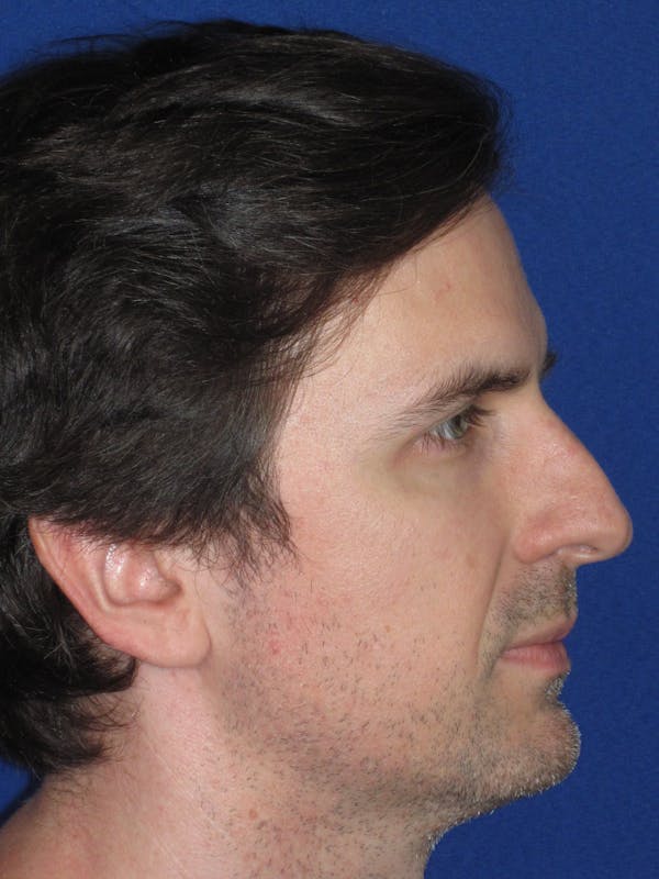 Rhinoplasty Before & After Gallery - Patient 323611 - Image 5