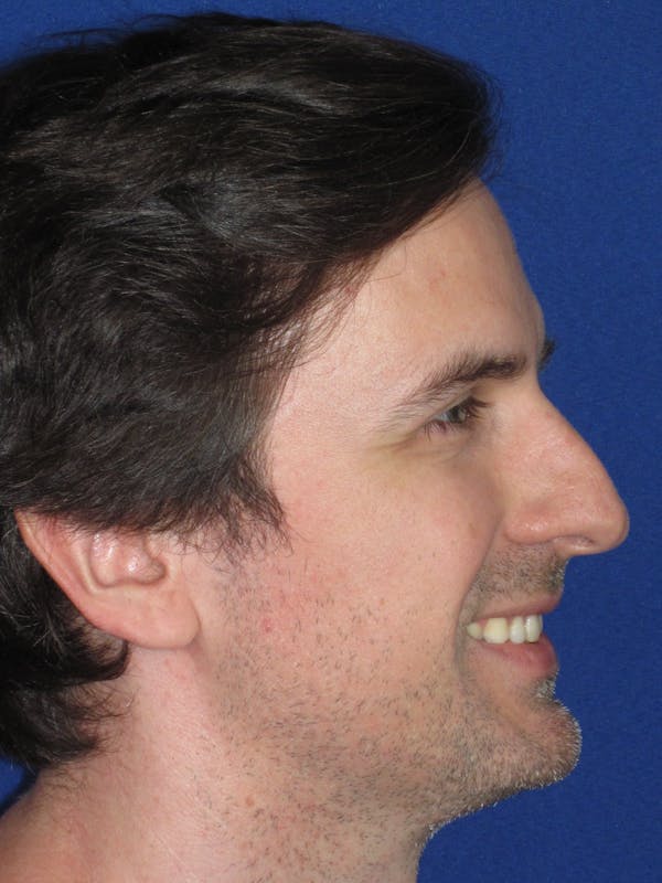 Rhinoplasty Before & After Gallery - Patient 323611 - Image 7