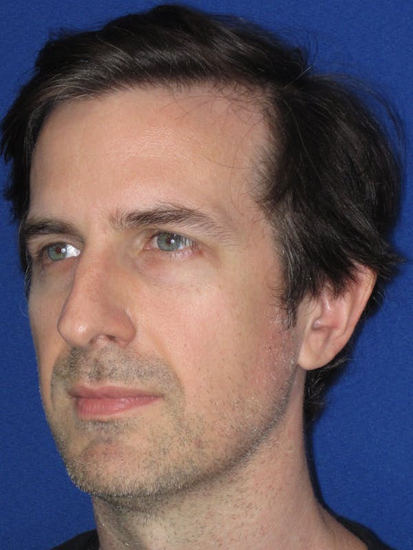 Rhinoplasty Before & After Gallery - Patient 323611 - Image 9