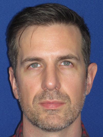 Rhinoplasty Before & After Gallery - Patient 323611 - Image 4