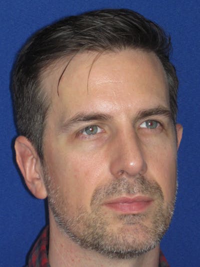 Rhinoplasty Before & After Gallery - Patient 323611 - Image 2