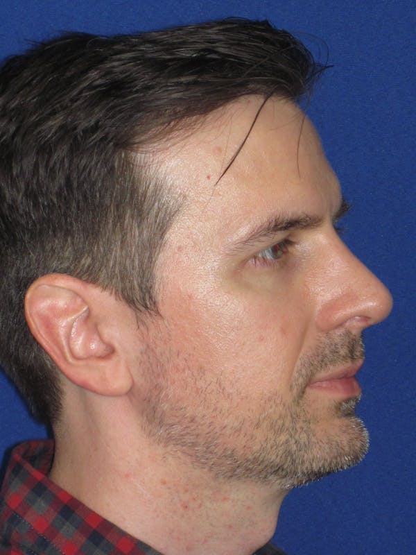 Rhinoplasty Before & After Gallery - Patient 323611 - Image 6