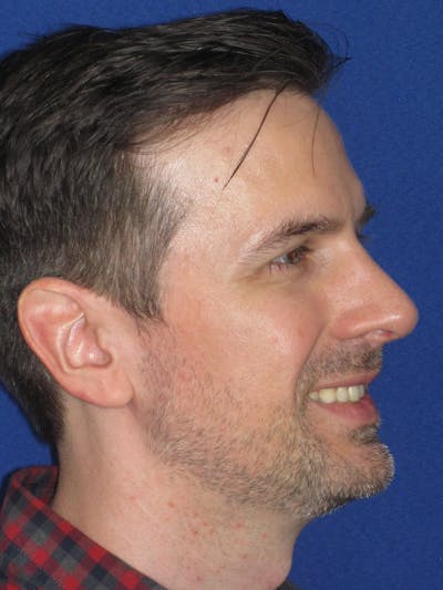 Rhinoplasty Before & After Gallery - Patient 323611 - Image 8