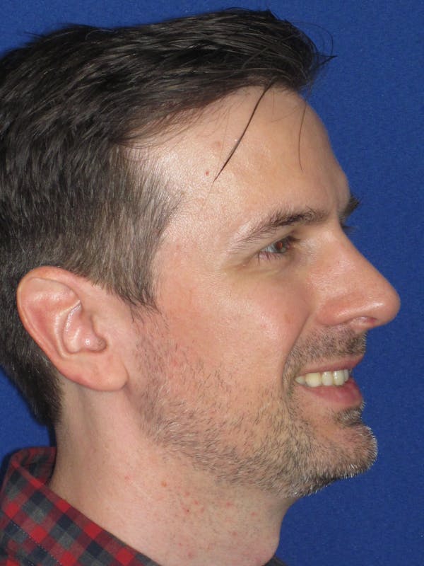 Rhinoplasty Before & After Gallery - Patient 323611 - Image 8