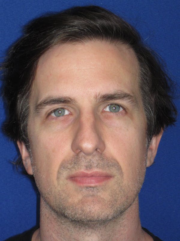 Rhinoplasty Before & After Gallery - Patient 323611 - Image 3