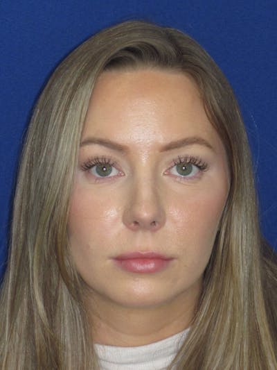 Rhinoplasty Before & After Gallery - Patient 177364 - Image 2