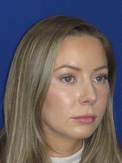 Rhinoplasty Before & After Gallery - Patient 177364 - Image 4