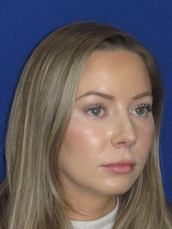 Rhinoplasty Before & After Gallery - Patient 177364 - Image 4