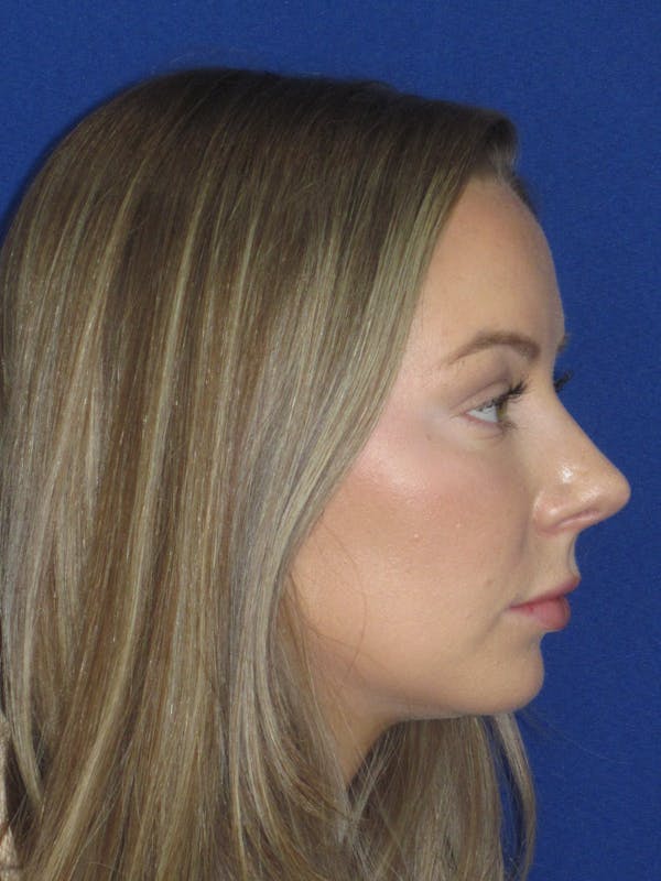 Rhinoplasty Before & After Gallery - Patient 177364 - Image 6